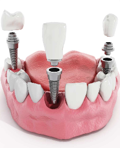 Screenshot 2021 01 28 Implantologia dentale a Verona Smile Gallery | Montagna Studi Dentistici | Dentista a Bovolone