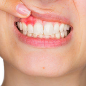 parodontite sintomi iniziali