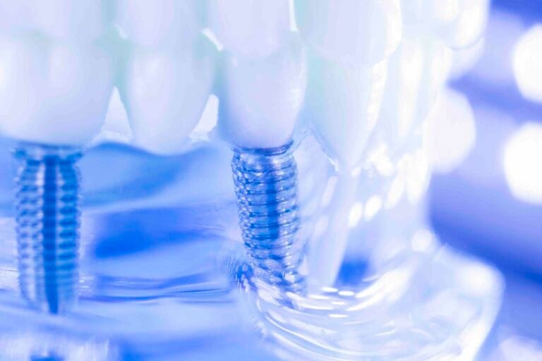 Impianto dentale a Verona Impianto dentale a Verona