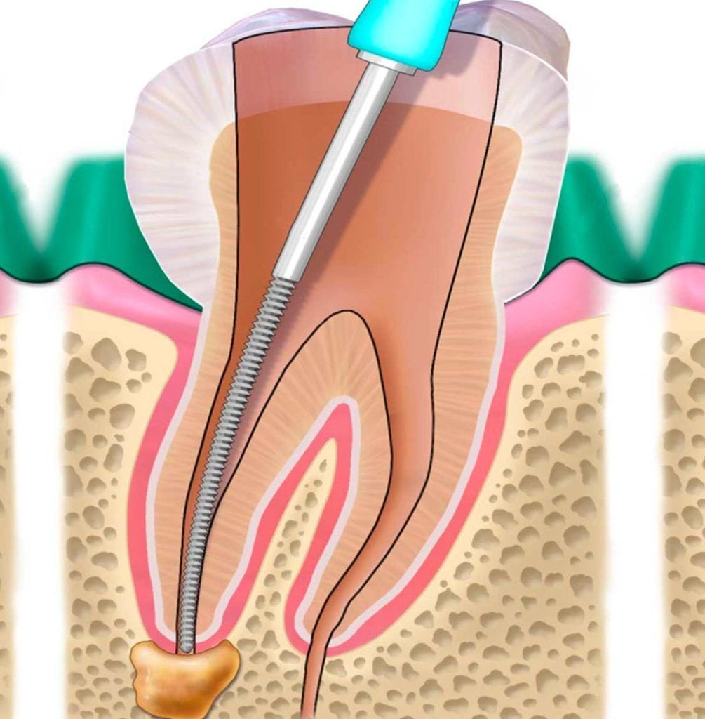 Endodonzia 1 devitalizzazione dente a Verona
