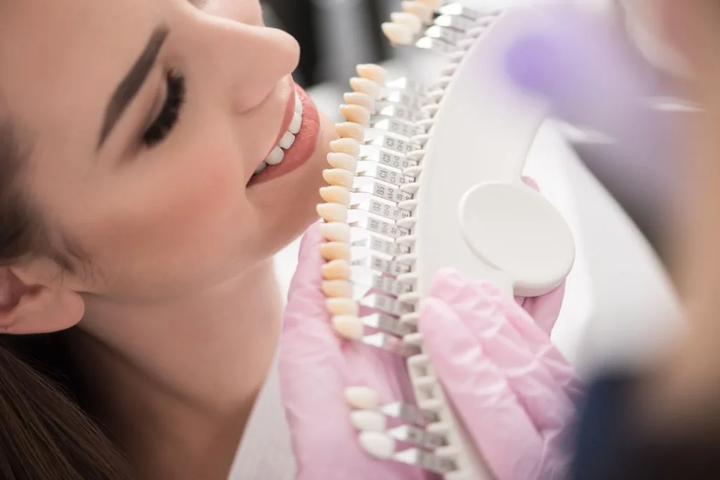 Quanto durano le faccette dentali? Tutto quello che devi sapere 1 quanto durano le faccette dentali
