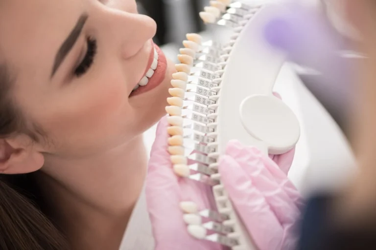 Blog 3 quanto durano le faccette dentali