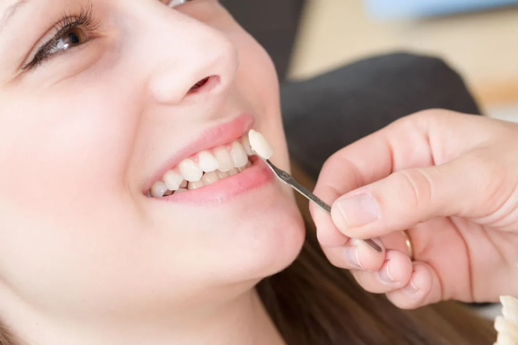 Cosa sono le faccette dentali e perché sceglierle? 1 cosa sono le faccette dentali