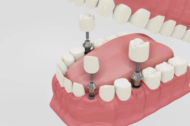 Blog 7 quanto dura un impianto dentale