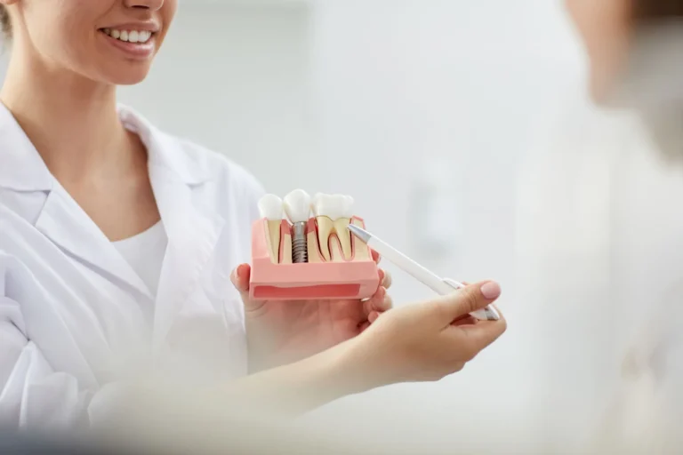 Blog 5 quanto tempo ci vuole per fare un impianto dentale