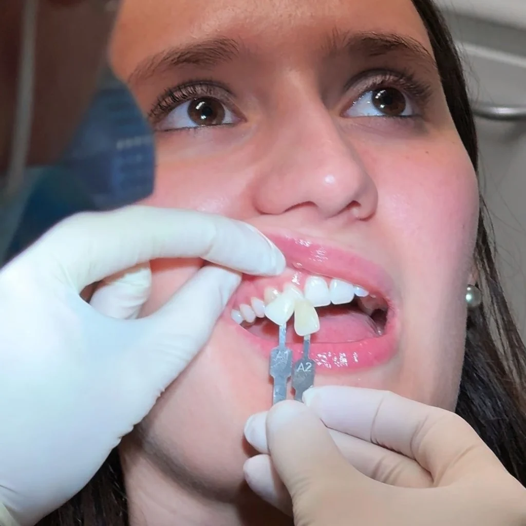 Faccette Dentali 6 Faccette dentali a Verona