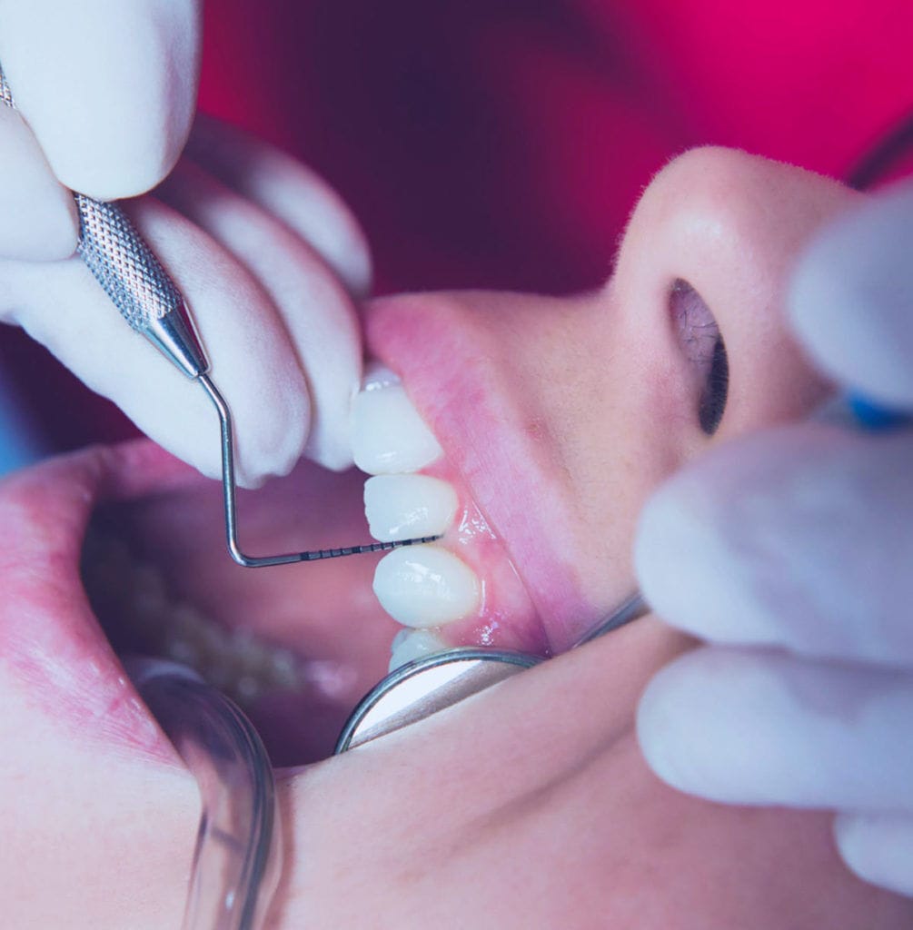 Parodontologia 1 Montagna Dentisti del Veronese