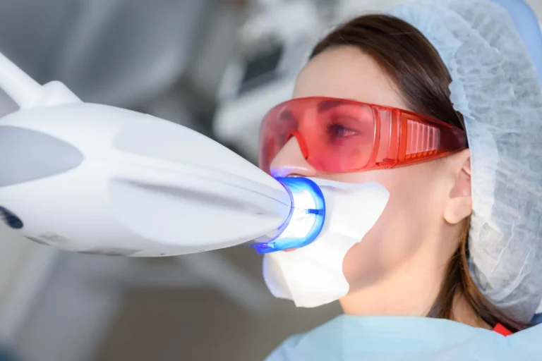 Blog 10 sbiancamento dentale