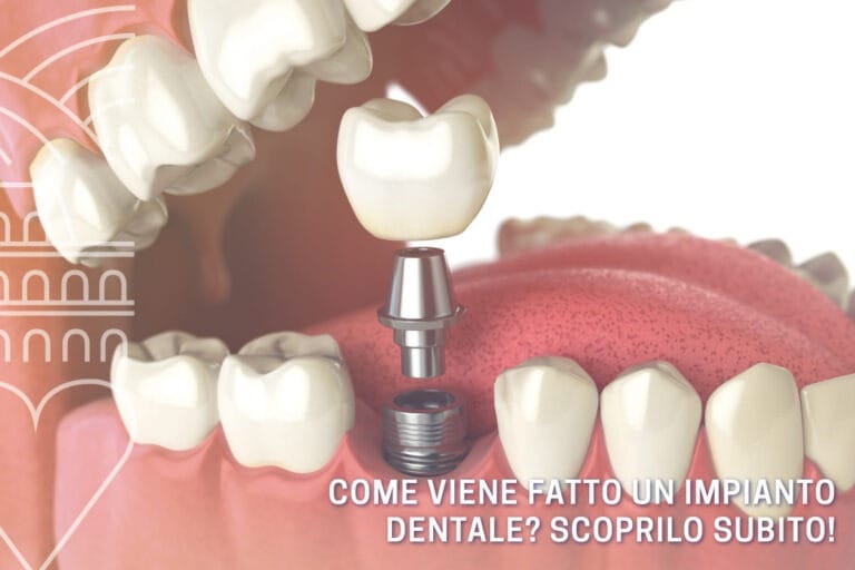 Blog 12 come-viene-fatto-un-impianto-dentale