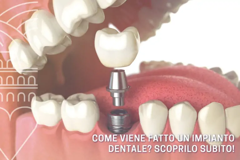 Blog 17 come-viene-fatto-un-impianto-dentale